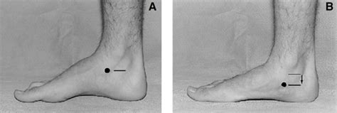 navicular tuberosity test